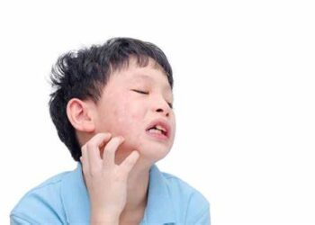 Penyakit Gondongan Mengintai Anak-anak, Kenali Penyebab, Cara Mencegah dan Mengobatinya