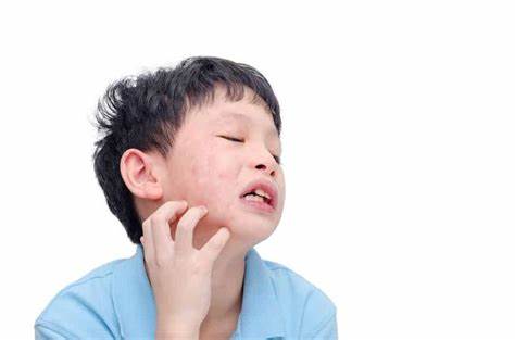 Penyakit Gondongan Mengintai Anak-anak, Kenali Penyebab, Cara Mencegah dan Mengobatinya